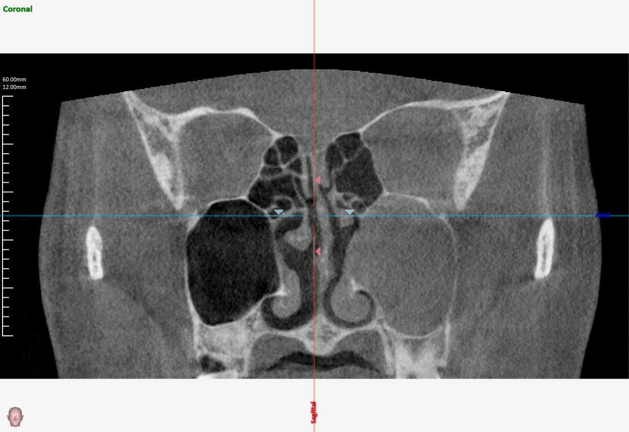 副鼻腔CT